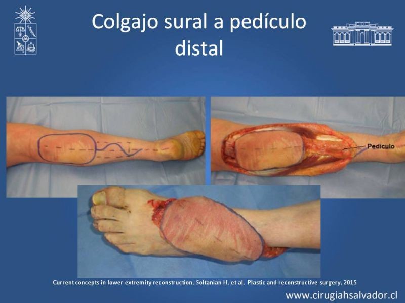 Diapositiva 43 de Cobertura miembro inferior