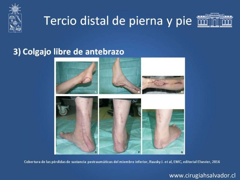 Diapositiva 41 de Cobertura miembro inferior