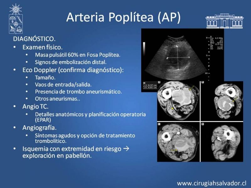 Diapositiva 8 de Aneurismas Periféricos