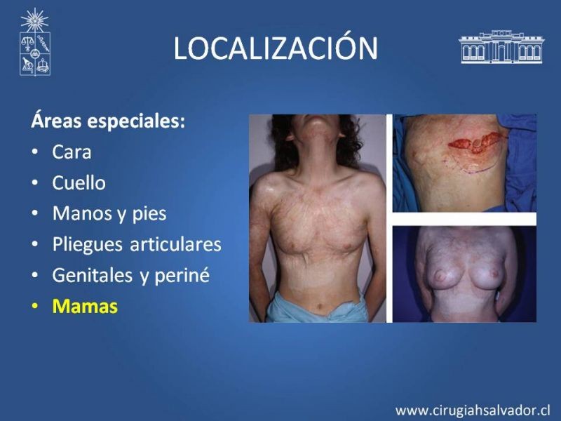 Diapositiva 30 de Gran quemado