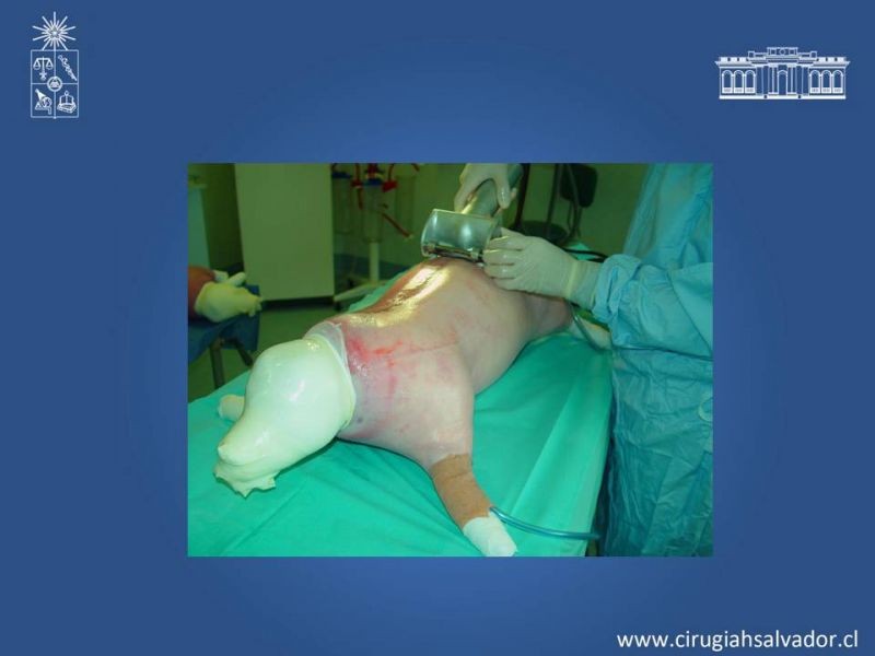 Diapositiva 47 de Gran quemado