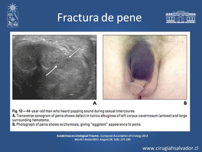 Diapositiva 39 de Lesiones de vía urinaria