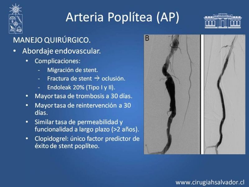 Diapositiva 16 de Aneurismas Periféricos