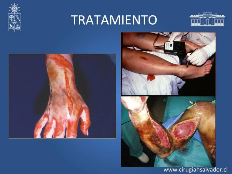 Diapositiva 39 de Gran quemado