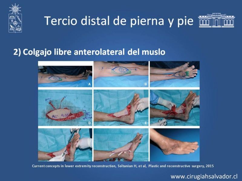 Diapositiva 40 de Cobertura miembro inferior