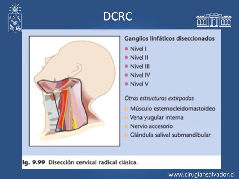 Diapositiva 26 de Metástasis cervical de primario desconocido