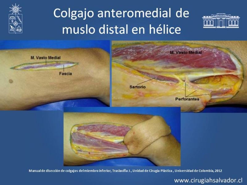 Diapositiva 26 de Cobertura miembro inferior
