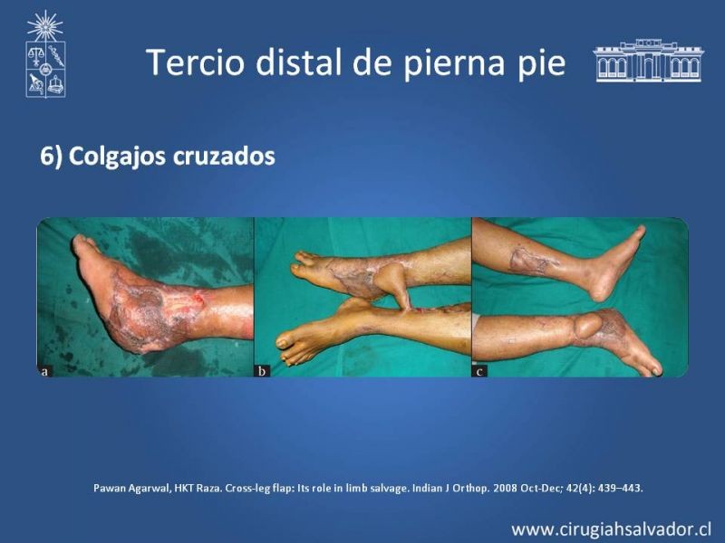 Diapositiva 49 de Cobertura miembro inferior