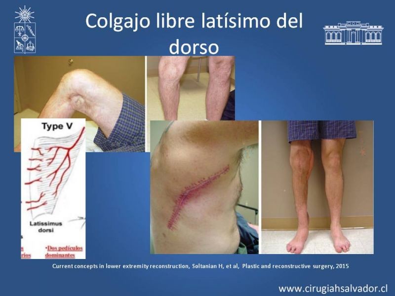 Diapositiva 28 de Cobertura miembro inferior