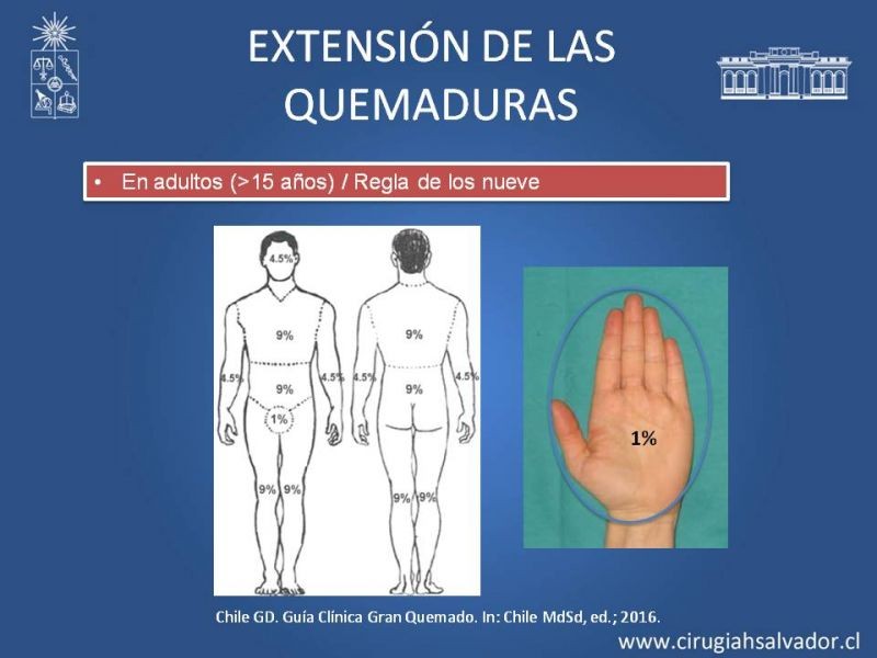 Diapositiva 17 de Gran quemado