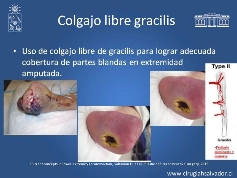 Diapositiva 29 de Cobertura miembro inferior
