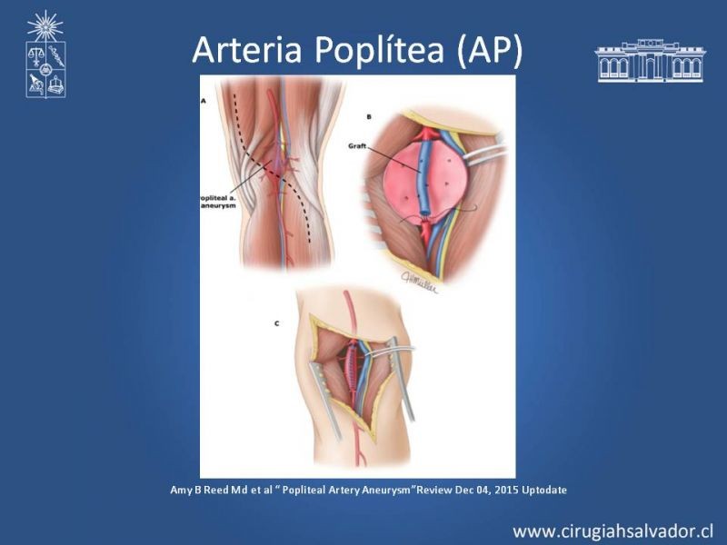 Diapositiva 15 de Aneurismas Periféricos