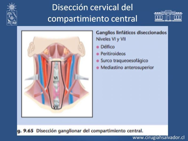 Diapositiva 30 de Metástasis cervical de primario desconocido