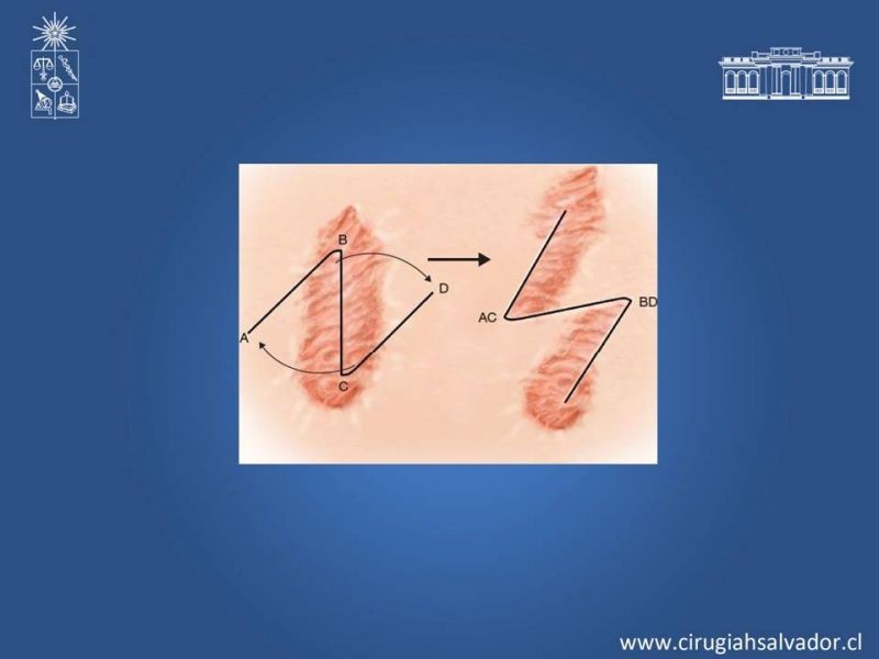 Diapositiva 31 de Gran quemado
