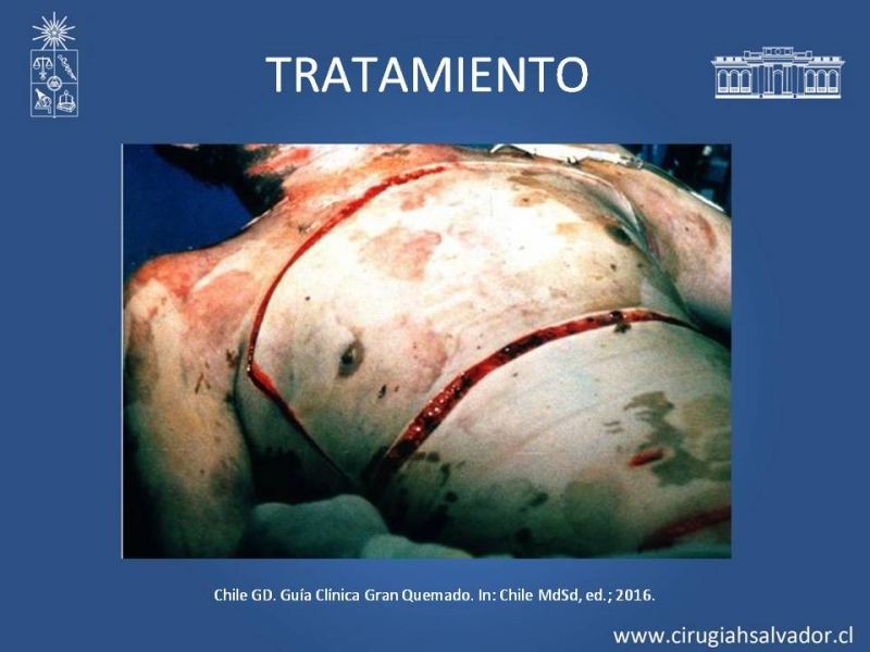Diapositiva 37 de Gran quemado