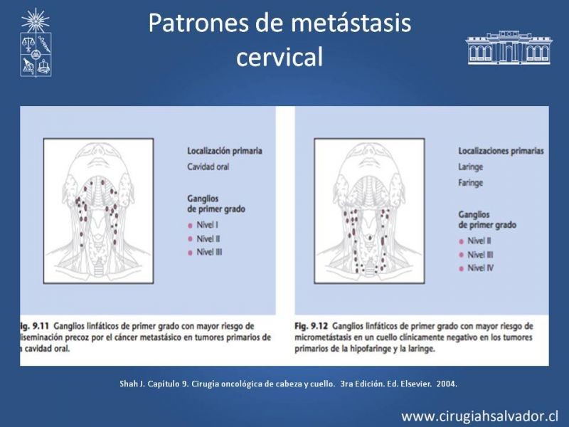 Diapositiva 6 de Metástasis cervical de primario desconocido