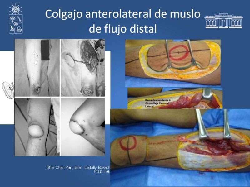 Diapositiva 24 de Cobertura miembro inferior