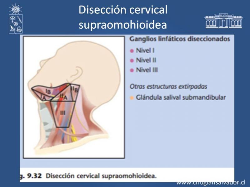 Diapositiva 29 de Metástasis cervical de primario desconocido