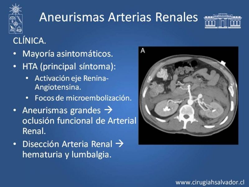 Diapositiva 41 de Aneurismas Periféricos