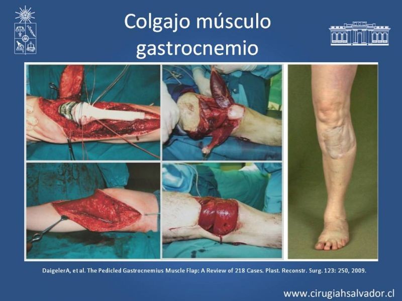 Diapositiva 22 de Cobertura miembro inferior