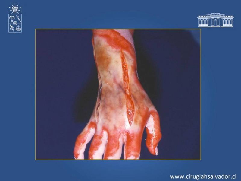 Diapositiva 22 de Gran quemado