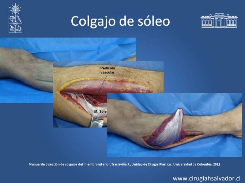 Diapositiva 35 de Cobertura miembro inferior