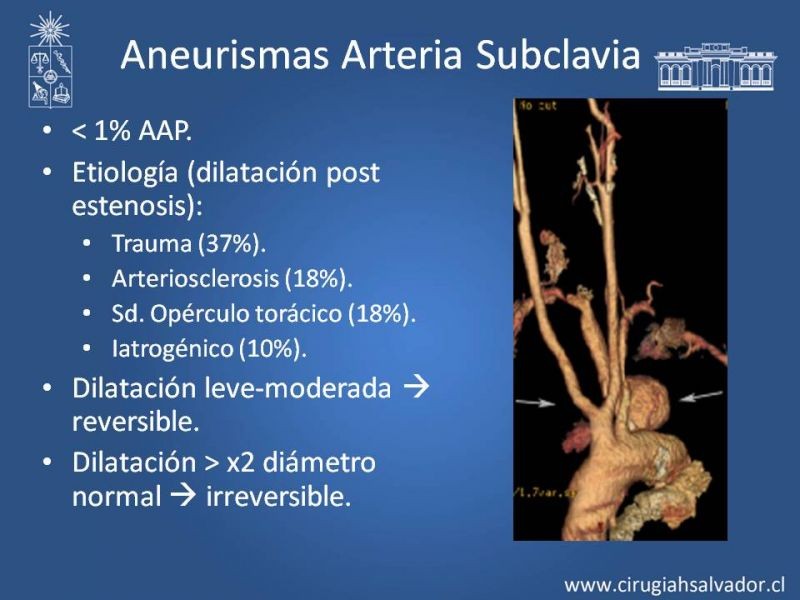 Diapositiva 47 de Aneurismas Periféricos