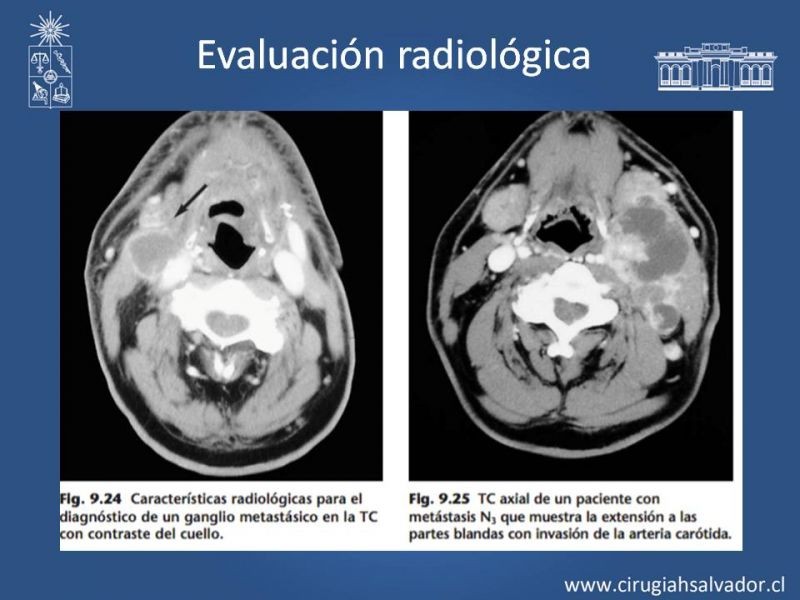 Diapositiva 17 de Metástasis cervical de primario desconocido