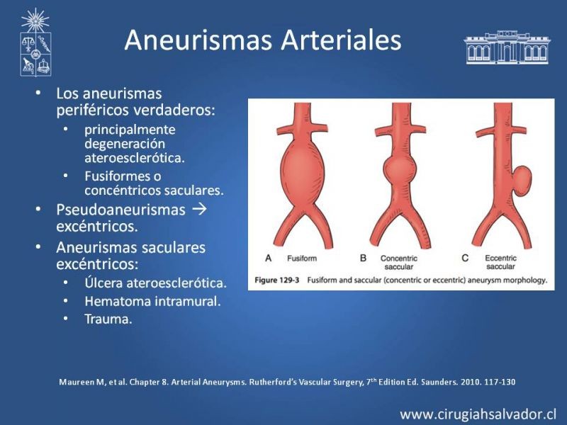 Diapositiva 5 de Aneurismas Periféricos