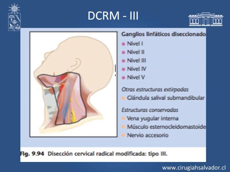 Diapositiva 27 de Metástasis cervical de primario desconocido