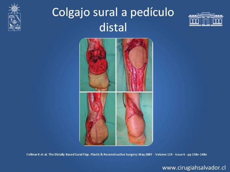 Diapositiva 44 de Cobertura miembro inferior