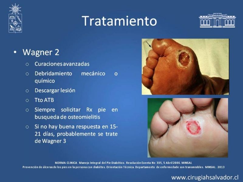 Diapositiva 20 de Pie Diabético