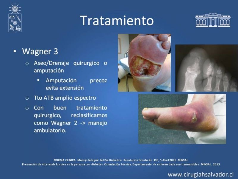 Diapositiva 21 de Pie Diabético
