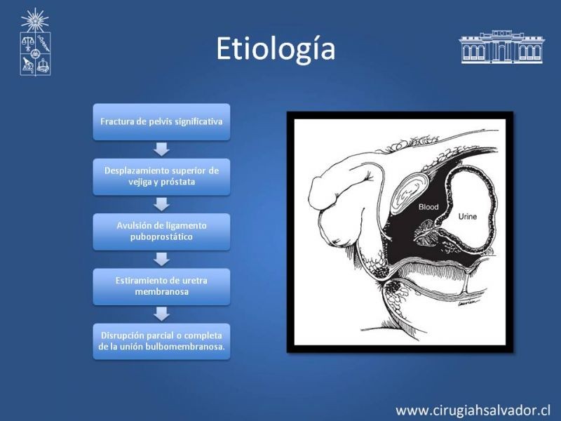 Diapositiva 9 de Trauma Uretral
