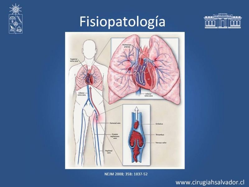 Diapositiva 5 de Prevención Enfermedad Tromboembólica
