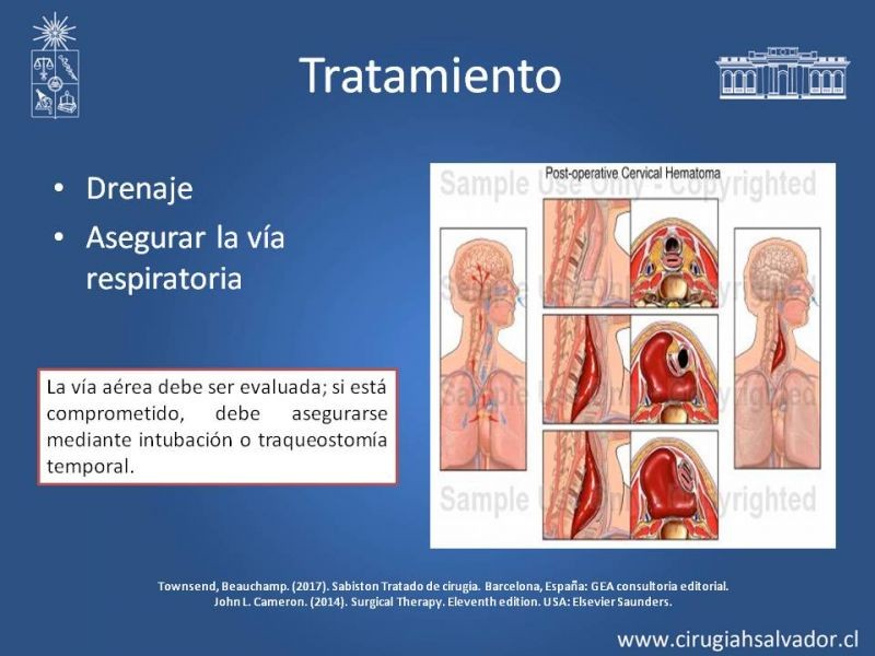 Diapositiva 17 de Hematoma Cervical