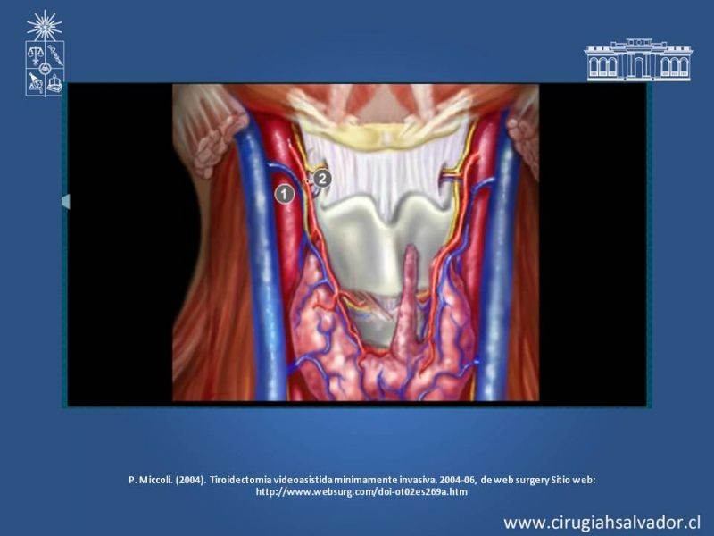 Diapositiva 4 de Hematoma Cervical