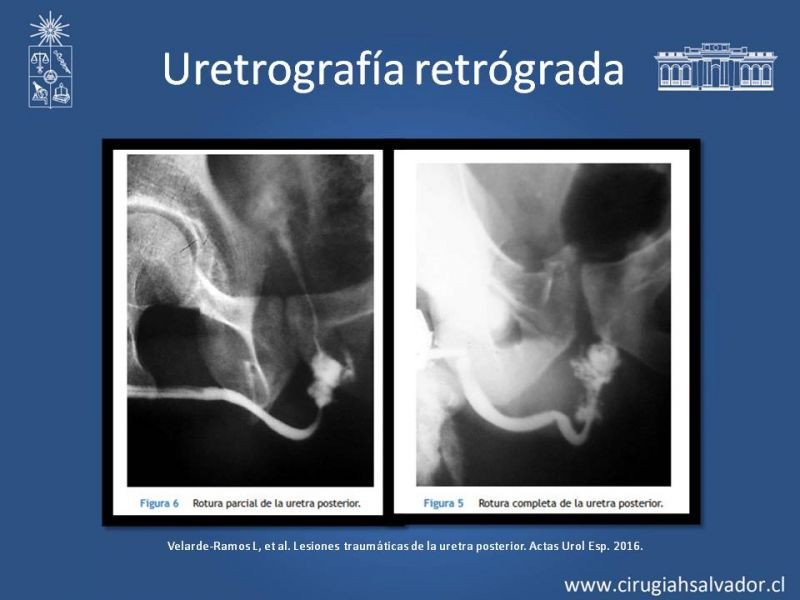 Diapositiva 18 de Trauma Uretral