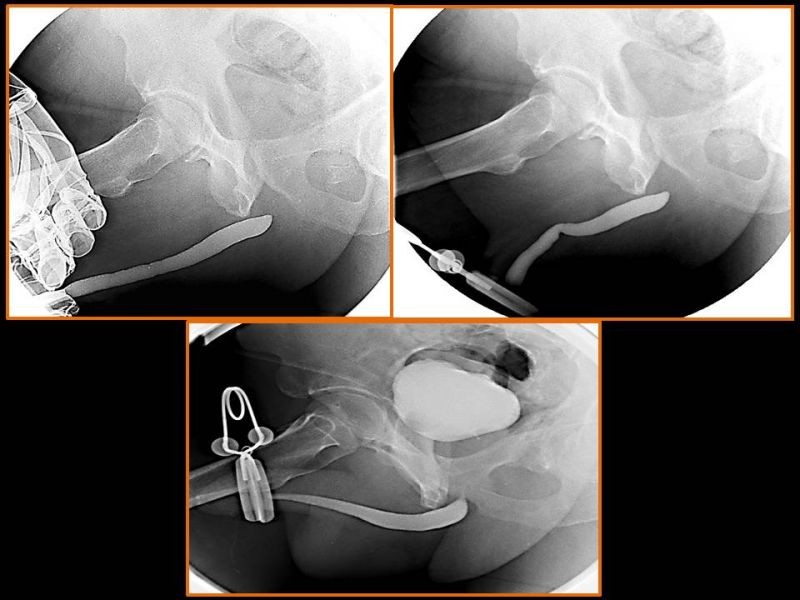 Diapositiva 29 de Trauma Uretral