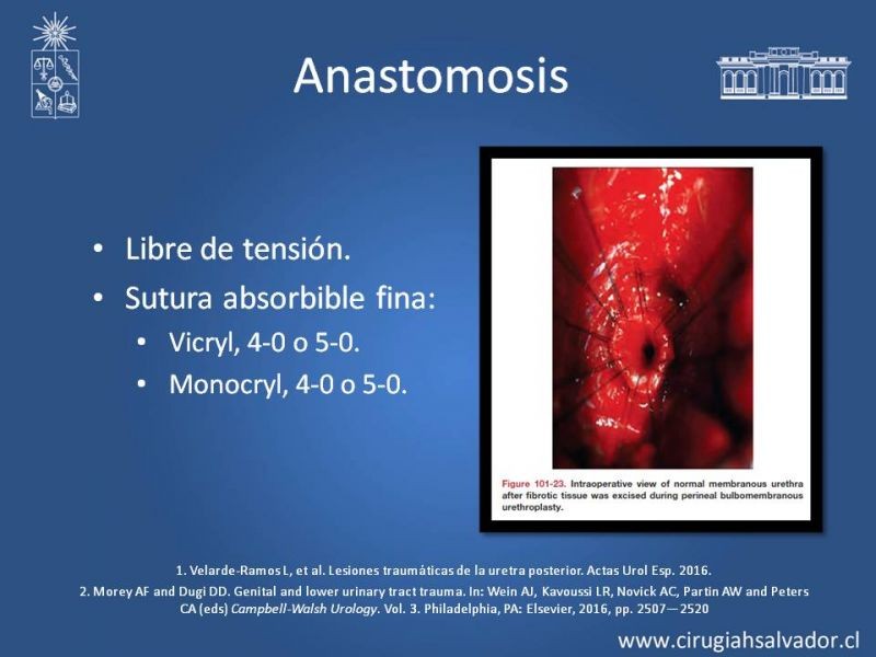 Diapositiva 33 de Trauma Uretral