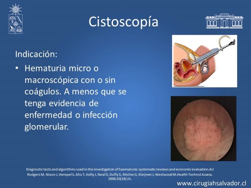 Diapositiva 15 de Hematuria: Hematuria-Urológica-Urgencias
