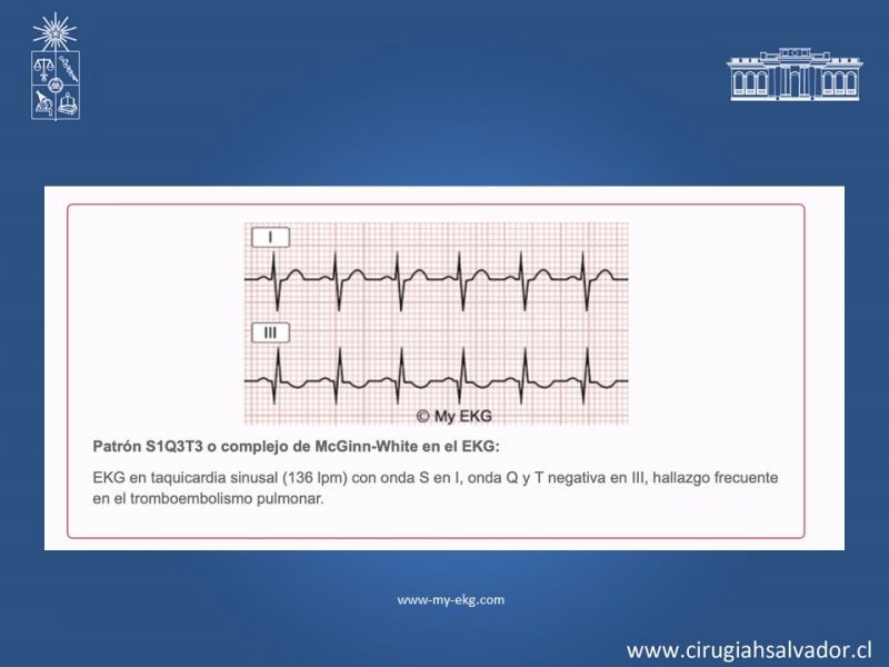 Diapositiva 17 de TEP masivo: Diagnóstico y tratamiento