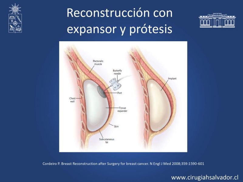 Diapositiva 9 de Reconstrucción mamaria