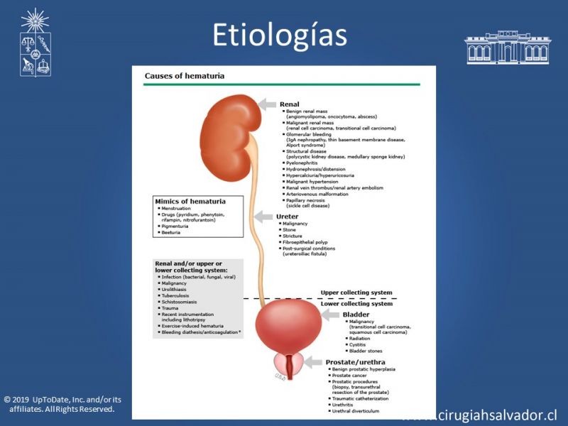 Diapositiva 6 de Hematuria: Hematuria-Urológica-Urgencias