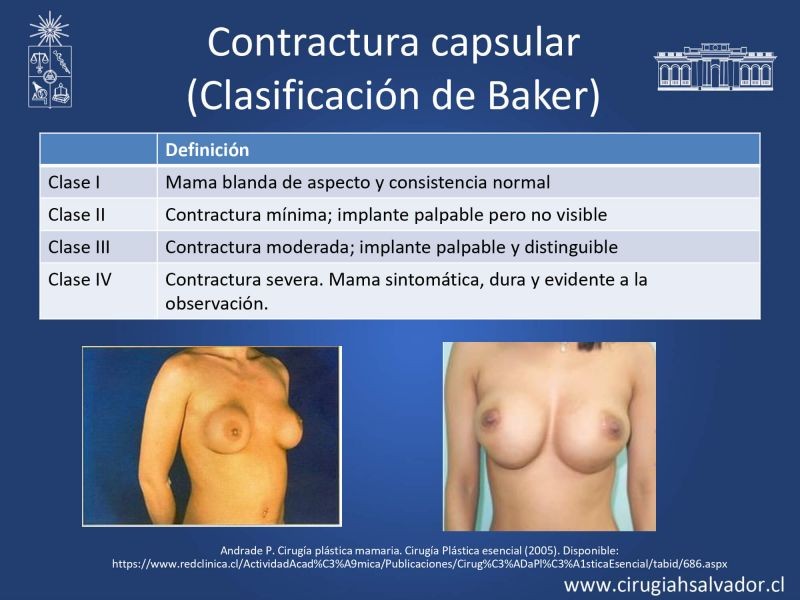 Diapositiva 14 de Reconstrucción mamaria