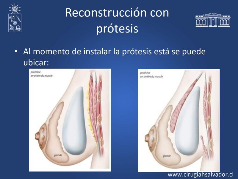Diapositiva 10 de Reconstrucción mamaria