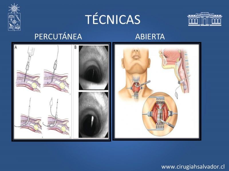 Diapositiva 7 de Traqueostomía