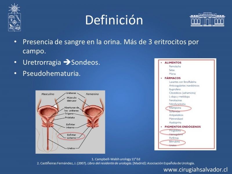 Diapositiva 1 de Hematuria: Hematuria-Urológica-Urgencias