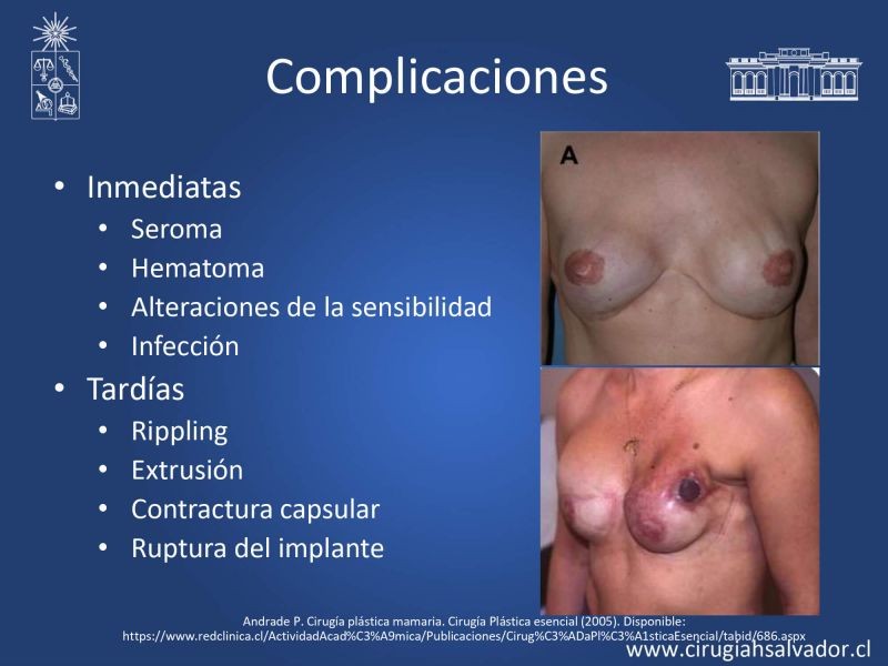 Diapositiva 13 de Reconstrucción mamaria