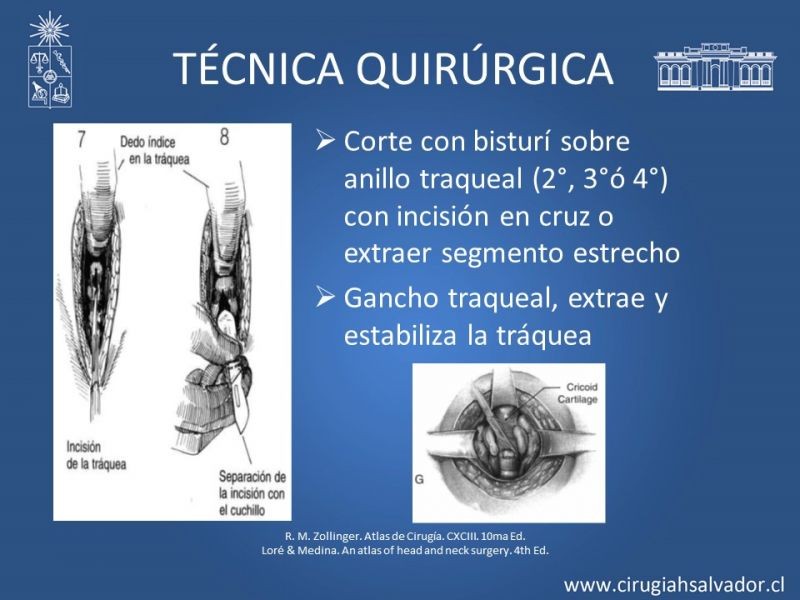 Diapositiva 12 de Traqueostomía